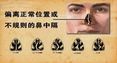 澳门新京棋牌：什么是鼻中隔偏曲？鼻中隔偏曲的危害有哪些？